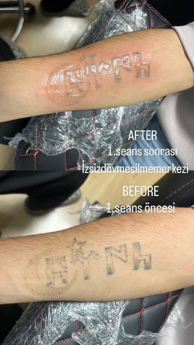 Dövme Silme Öncesi Sonrası